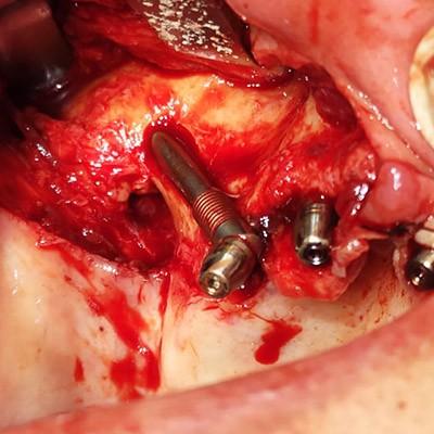 implantology implantologia