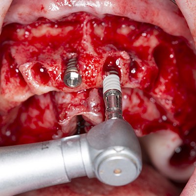 surgery experience dental innovation cursos clinicos pacientes cirugia oral course