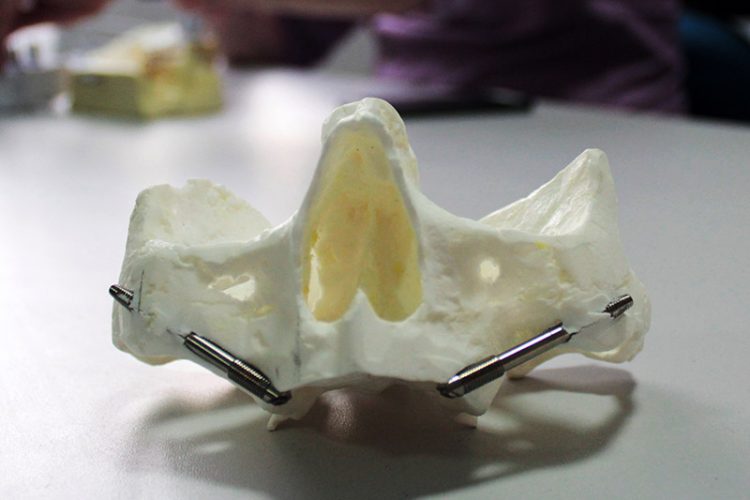 zygoma surgery experience curso zigomaticos modelos 3d dental innovation